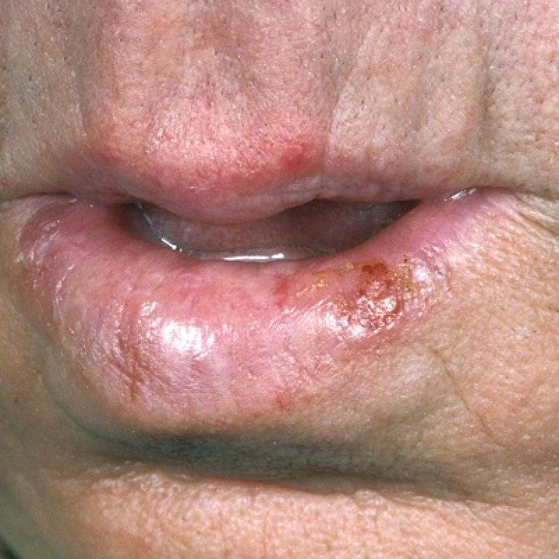 plaveiselcelcarcinoom lip